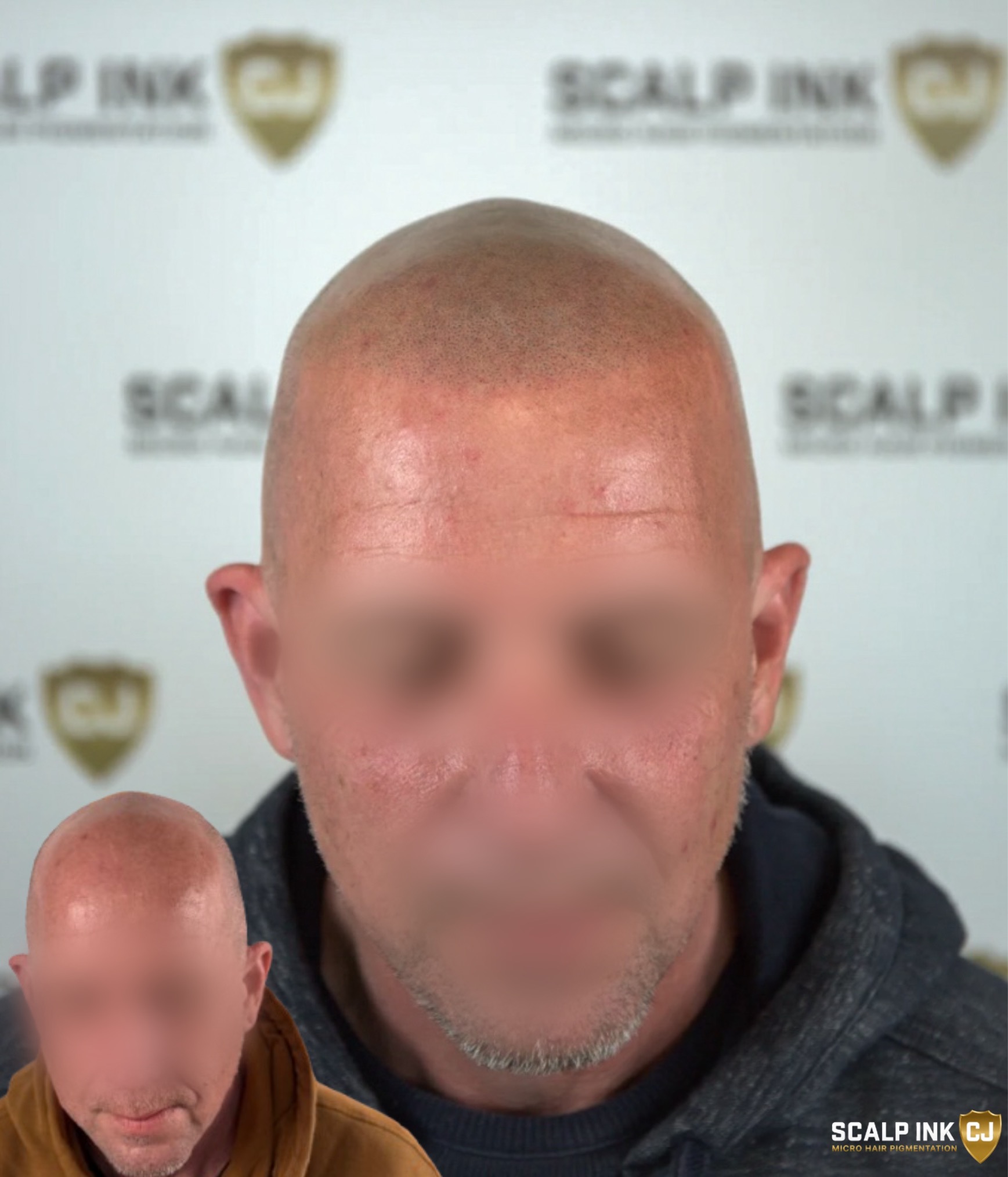 micro scalp pigmentation