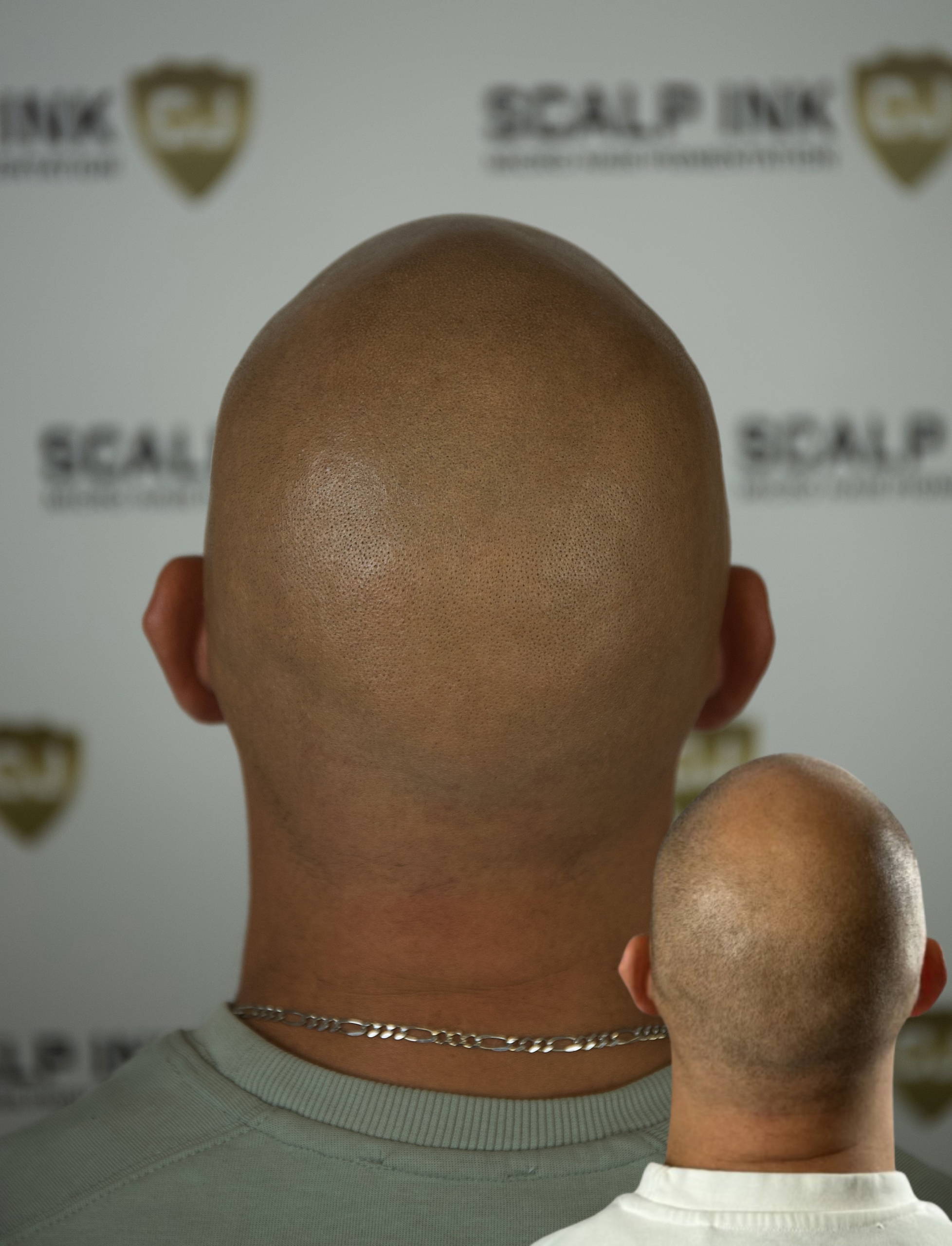 micro hair pigmentation