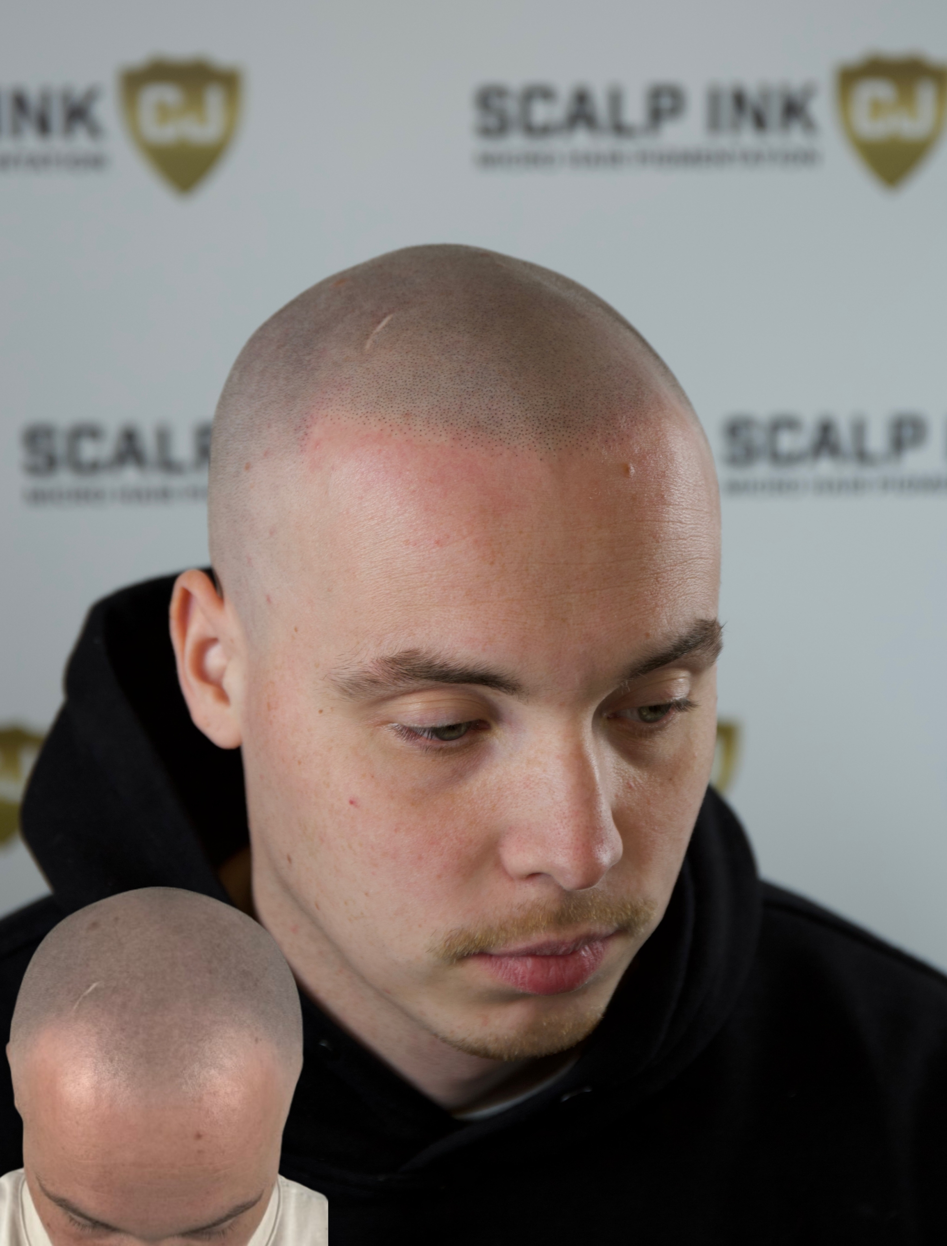 Micro Hair Pigmentation Rijswijk